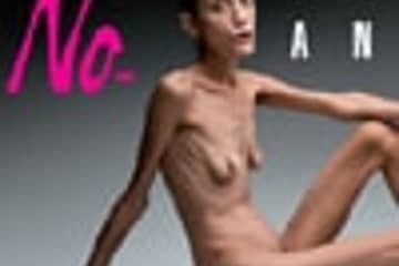 Impactante campaña de Oliverio Toscani contra la anorexia